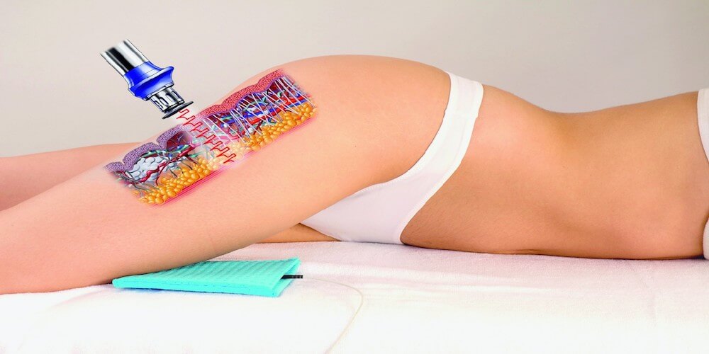 Cellulite Treatments procedure