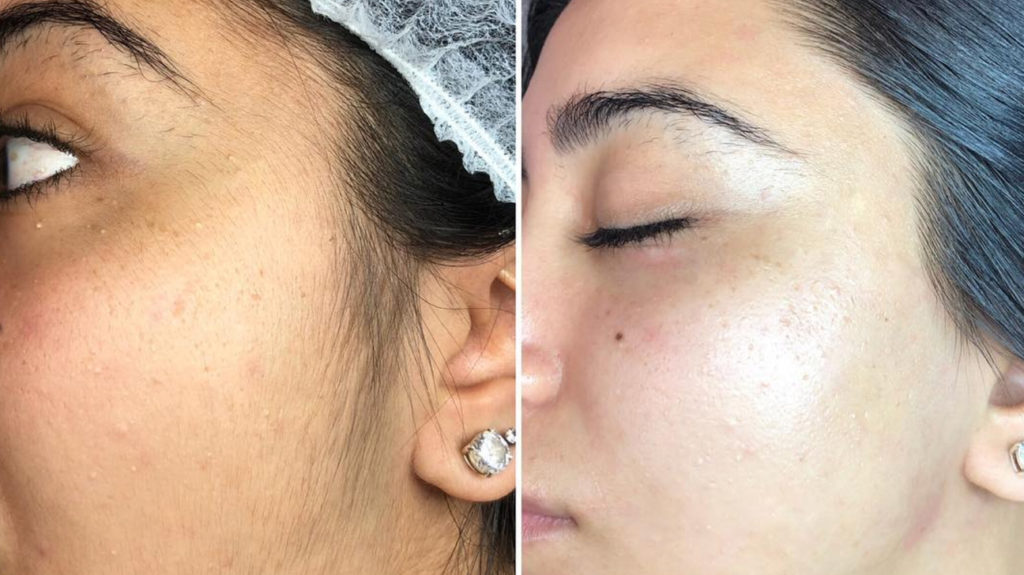 Dermaplaning before and after