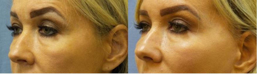 Filler procedure