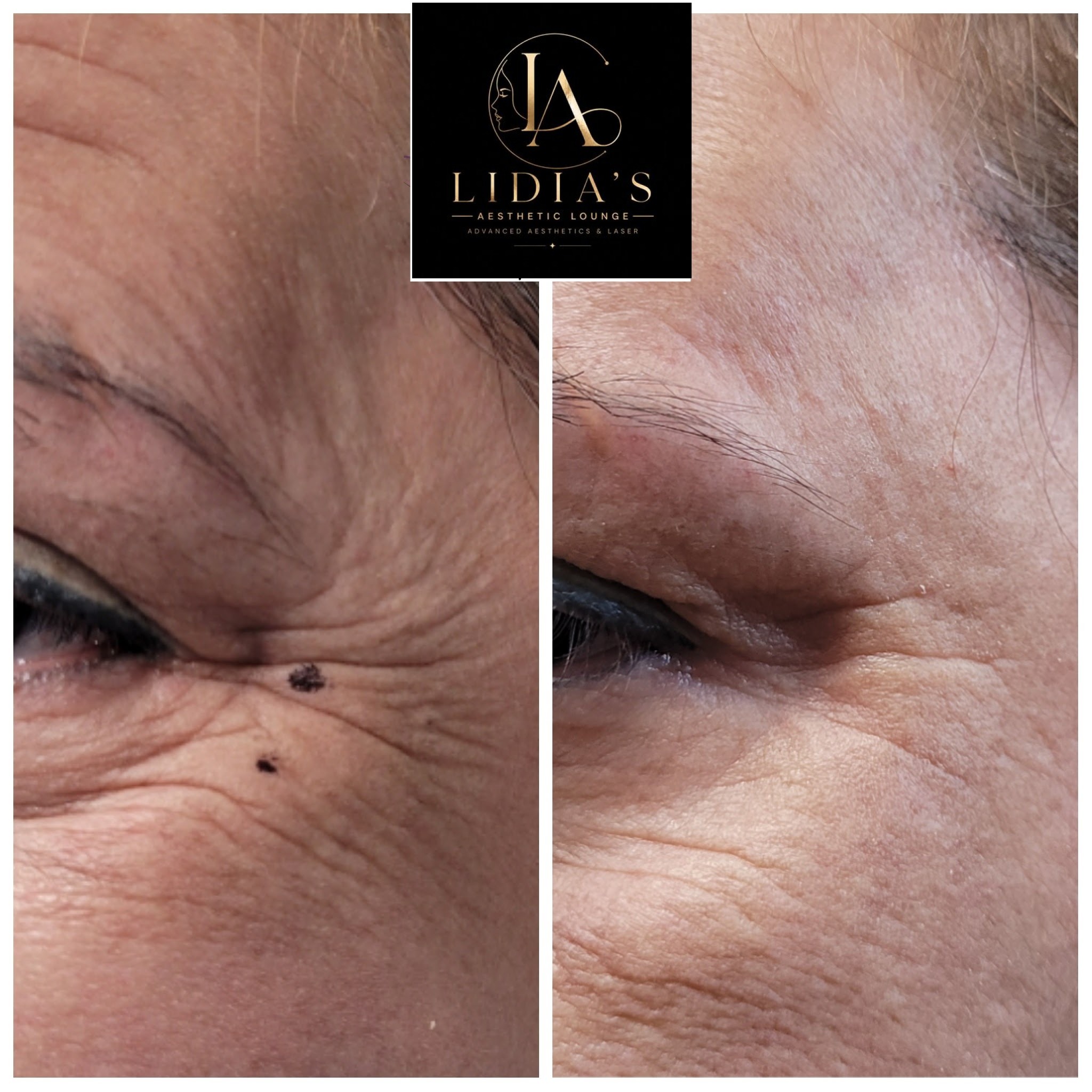 Botox Results
