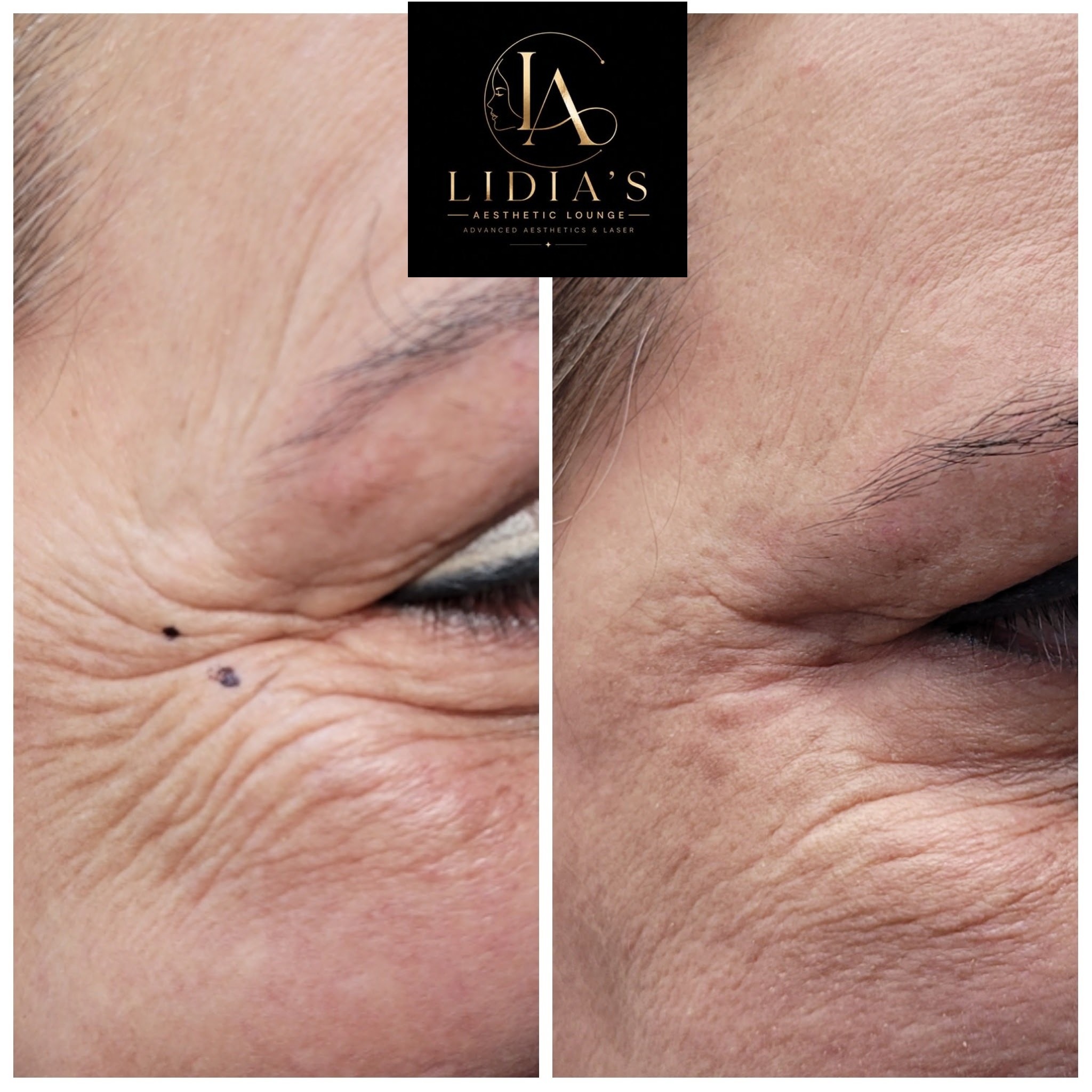 Botox Before and After