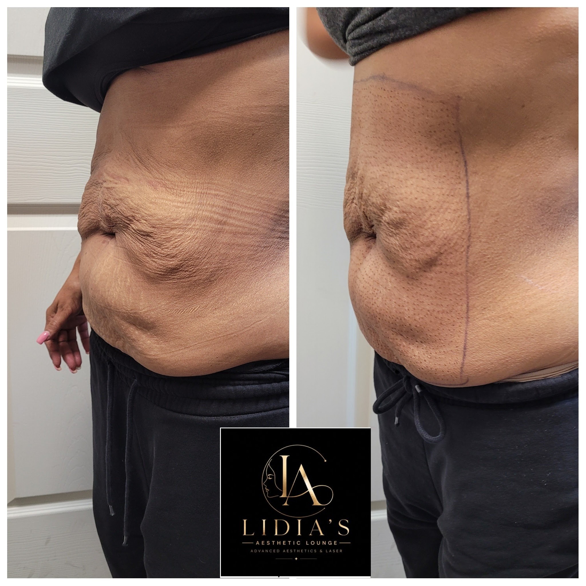 Fibroblast Plasma Results