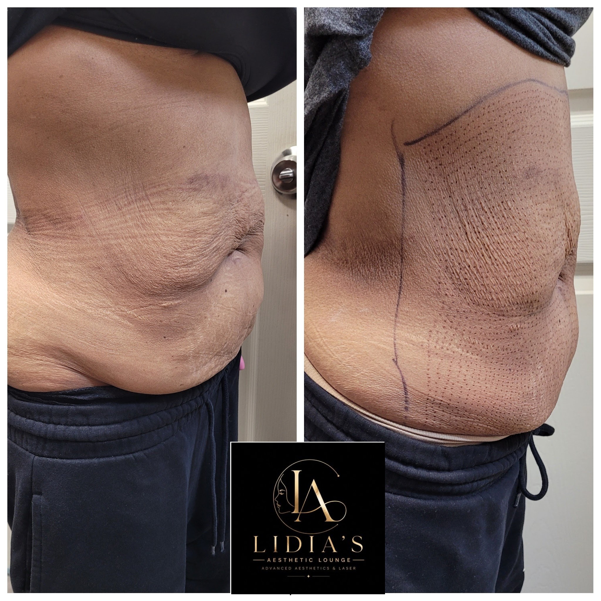 Fibroblast Plasma Results