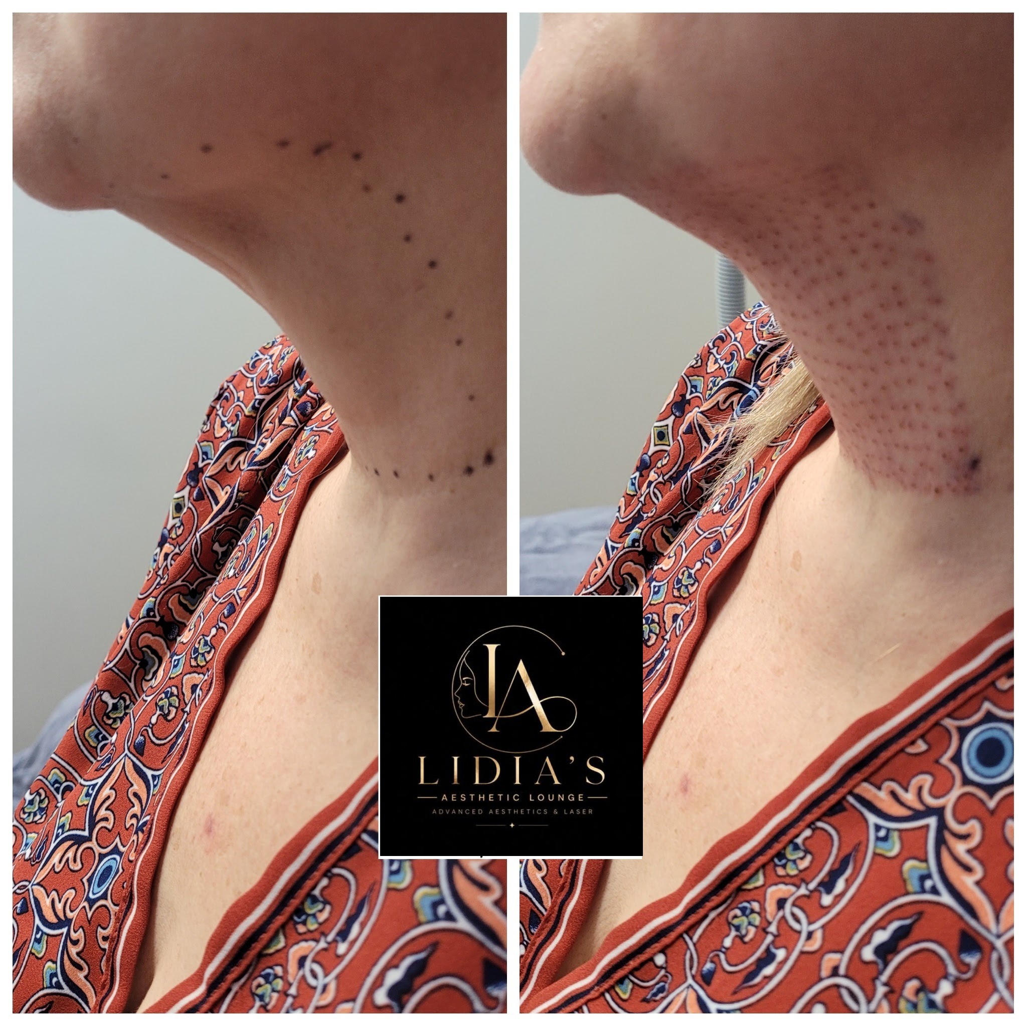Fibroblast Plasma Before and After