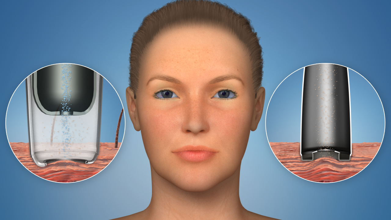 Microdermabrasion