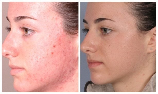 Microdermabrasion before and after