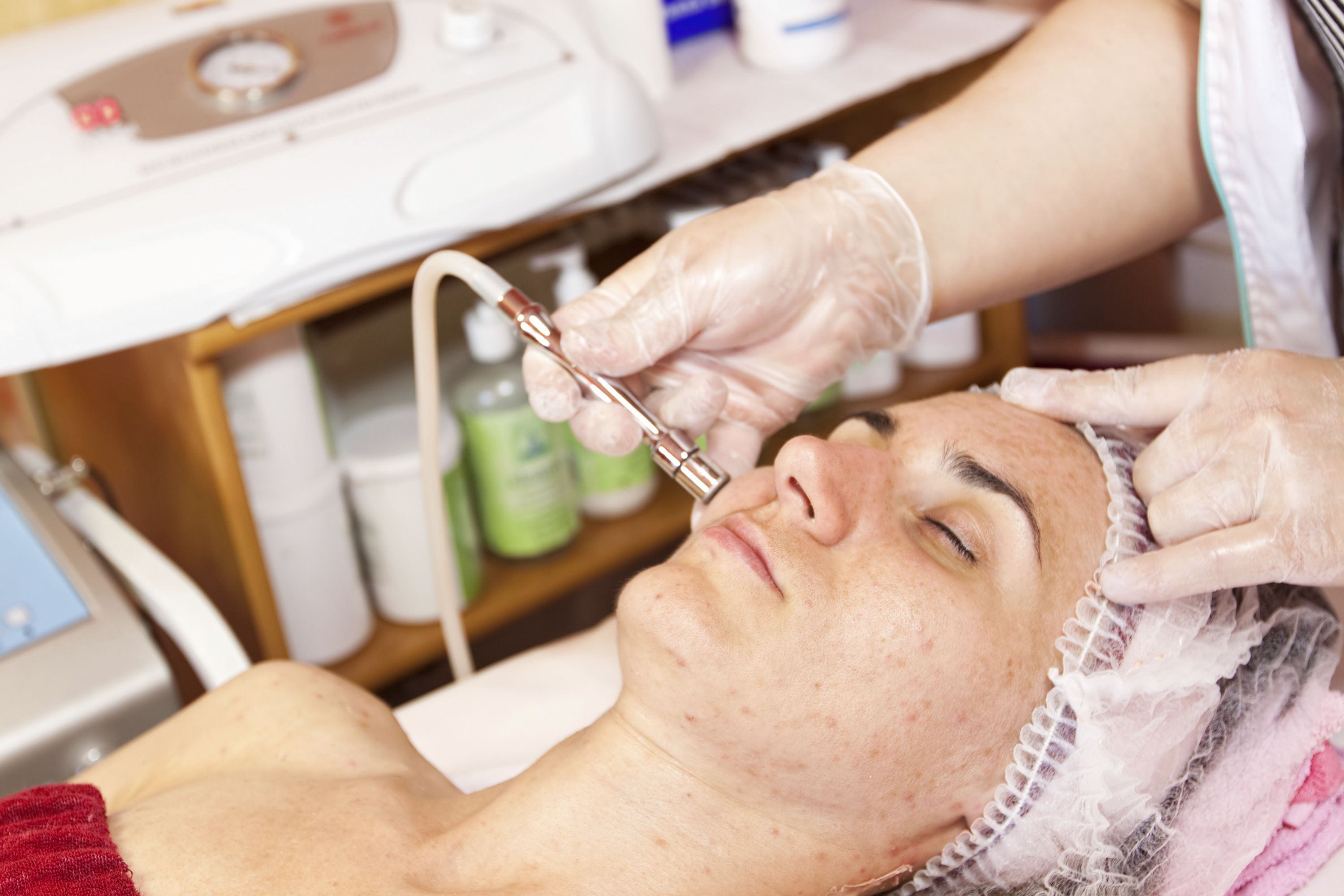 Microdermabrasion procedure