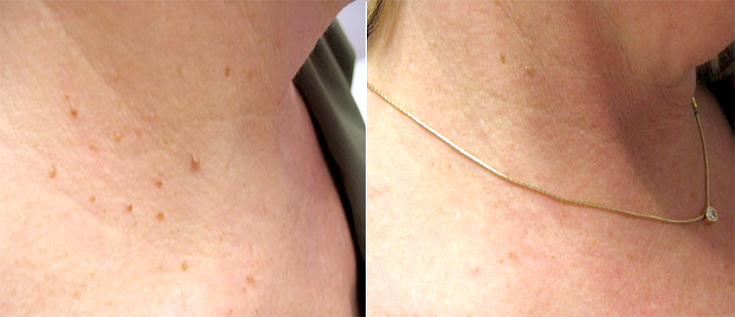 Skin Tightening Radiofrequency before and after