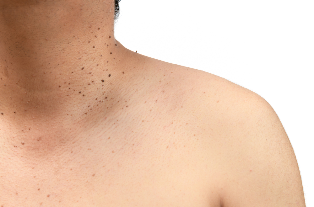 Skin Tag Removal procedure