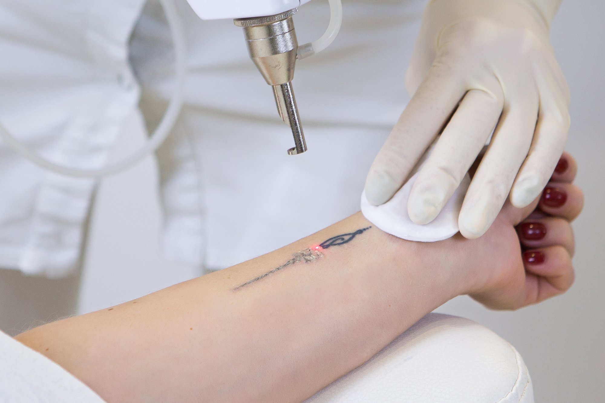 Tattoo Laser Removal