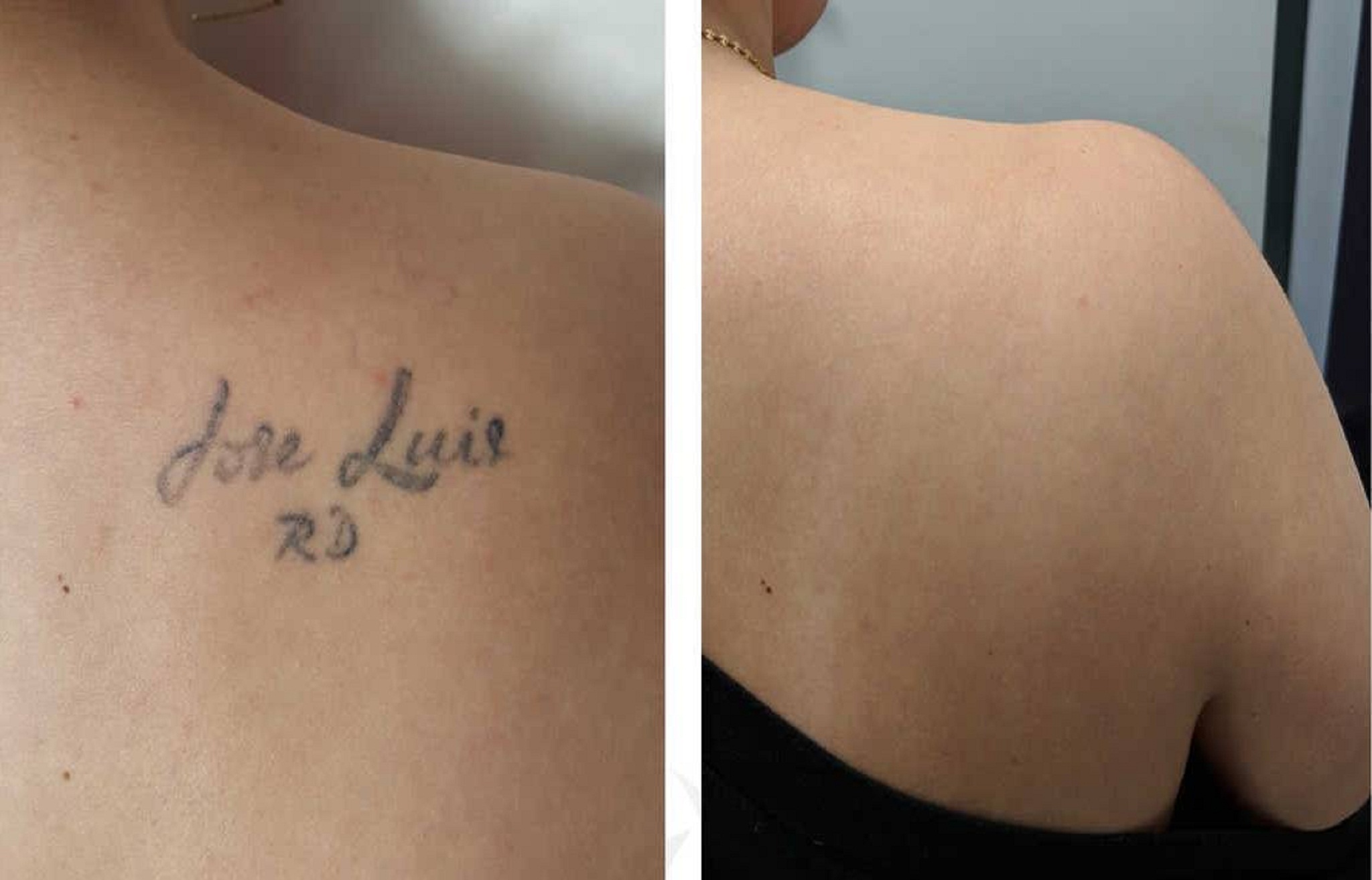 Tattoo Laser Removal before and after