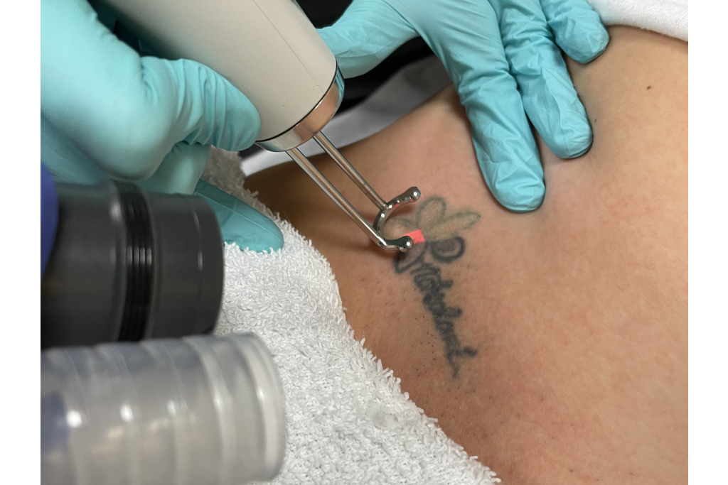 Tattoo Laser Removal